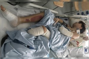 Dawid stracił rękę i nogę. Trwa zbiórka na protezy bioniczne
